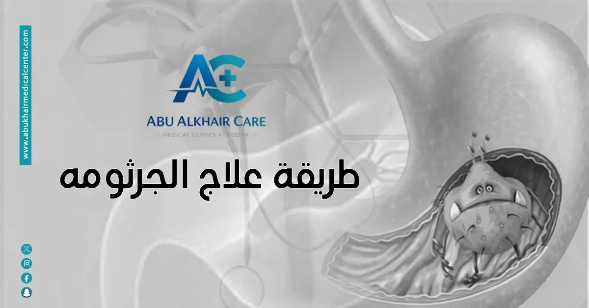 طريقة علاج الجرثومه